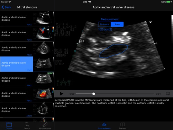Atlas of 3D echocardiography online access included