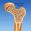 Brittle Bone Disease 101:Research,Symptoms and Treatment heart disease treatment 