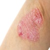 How To Treat Eczema treat software 